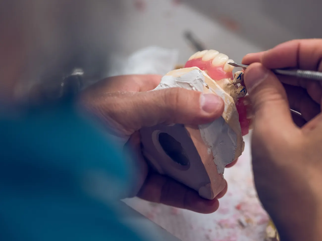 How are dental implants placed, step by step?
