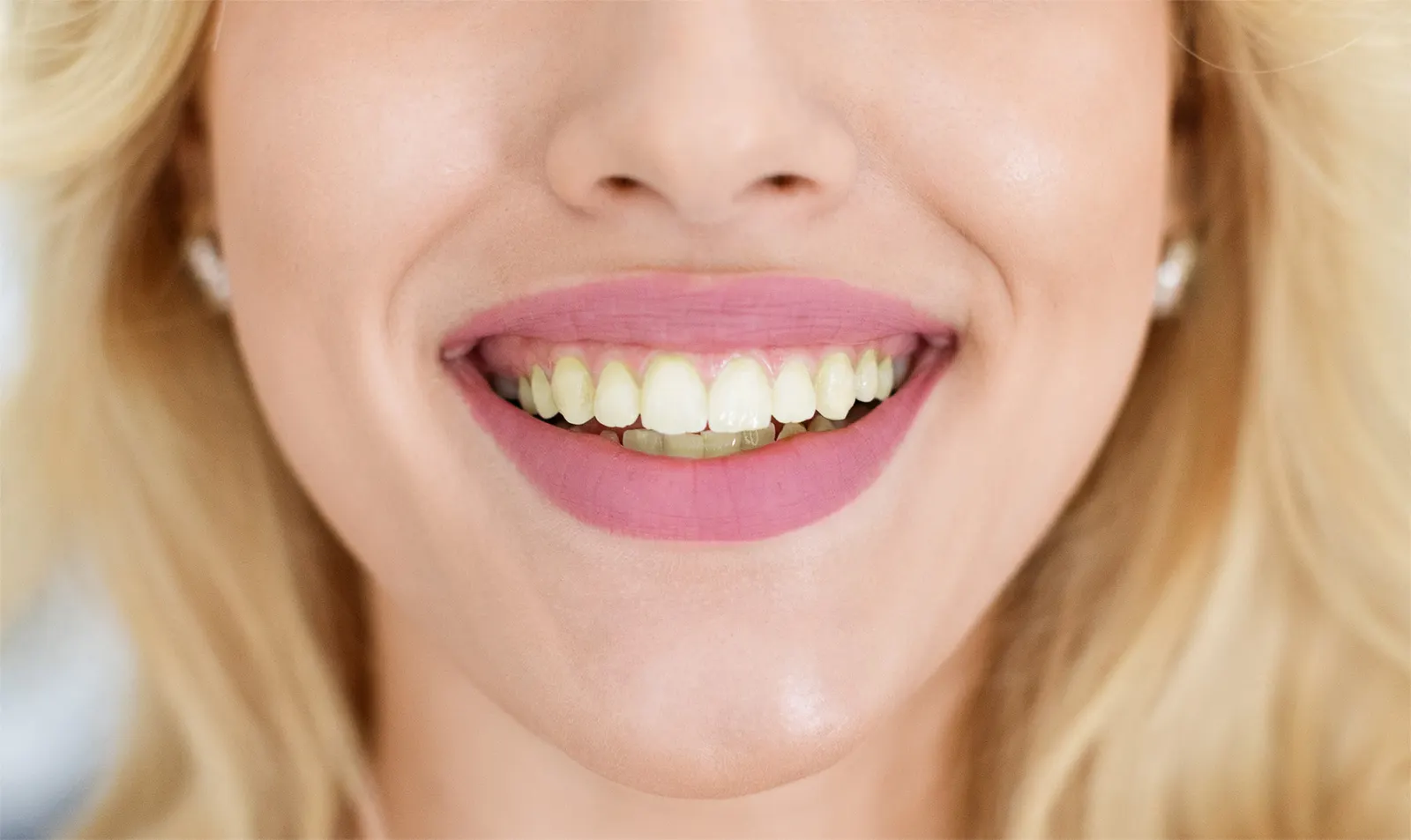 What is a porcelain veneer?