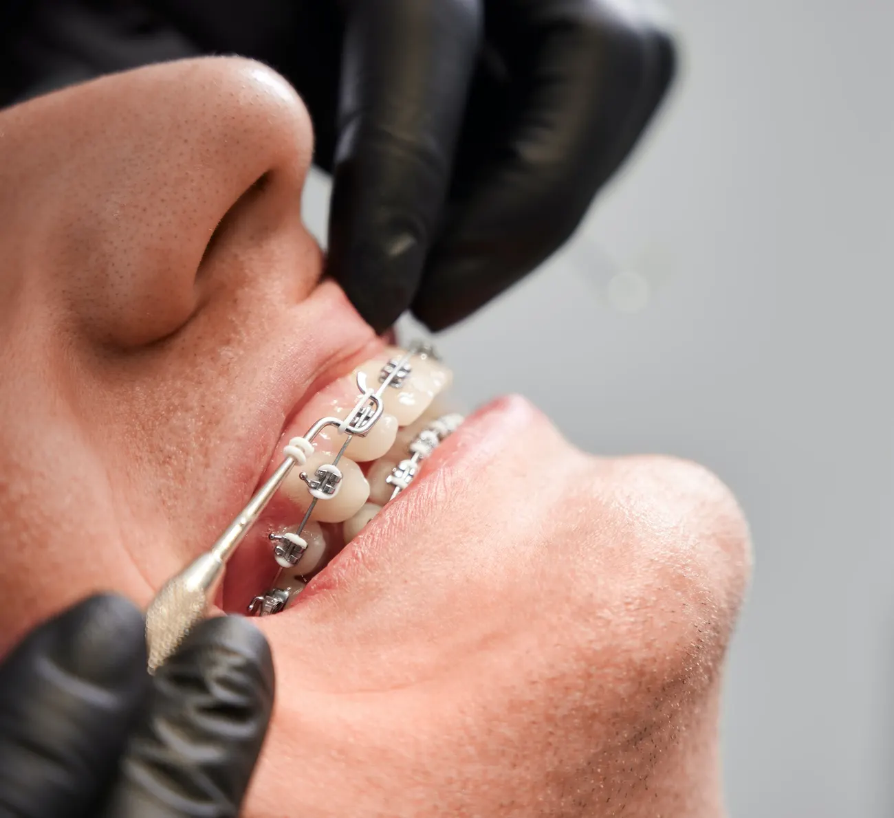 Clear Aligners at Northern Smiles Dentistry