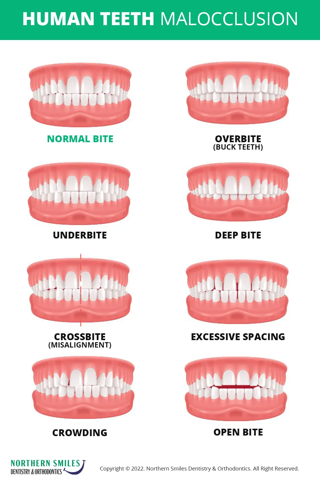 What Clear Aligners Can and Cannot Fix