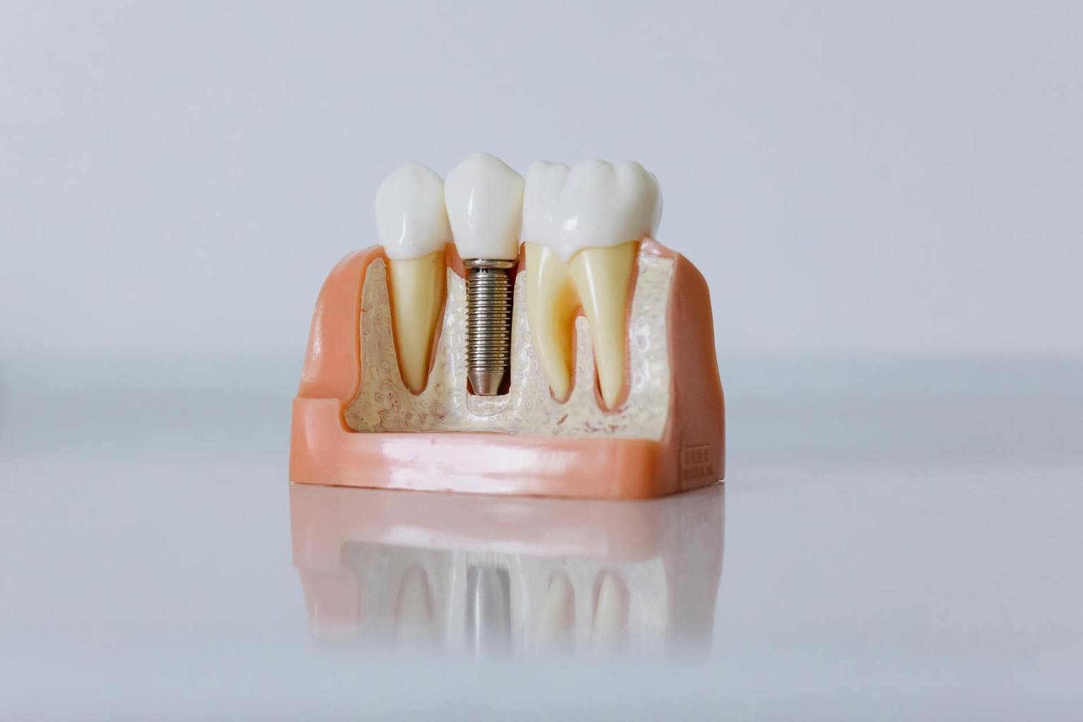 What is the downside of having dental implants? 1 close up shot of dental implant model
