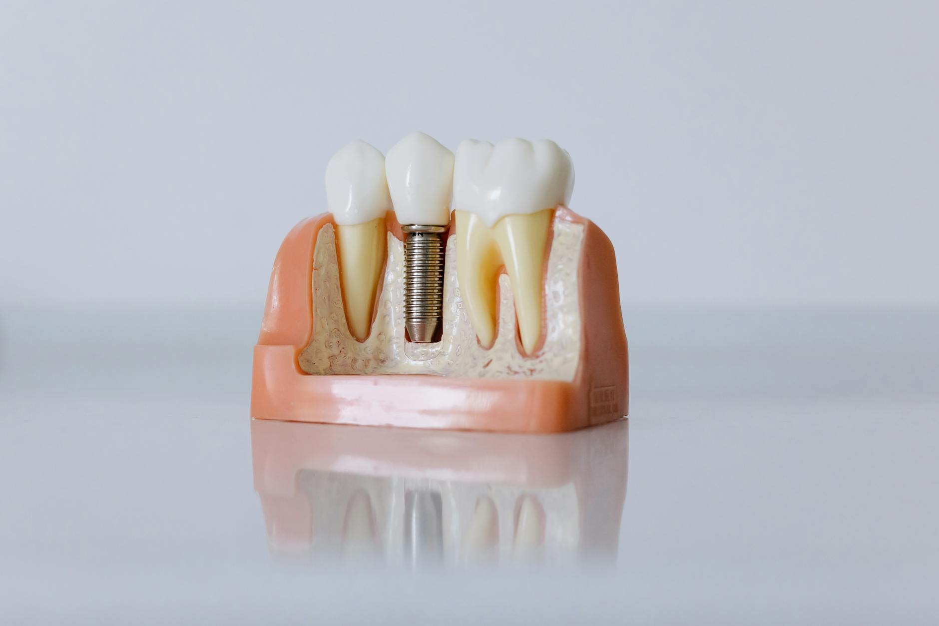 What is the downside of having dental implants? 2 close up shot of dental implant model
